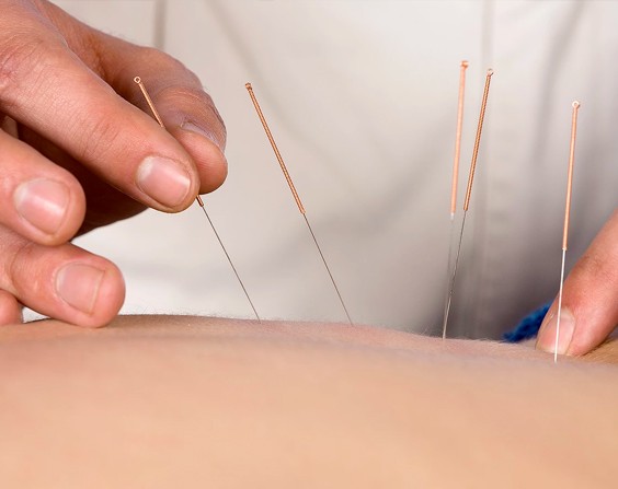 Acupuncture