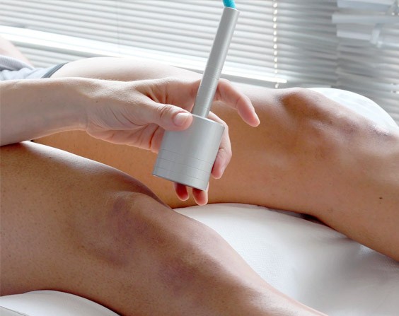 Laser-Treatments-Legs